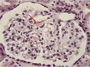 Image of the glomerulus of the patient stained with Congo red (40×), showing positivity for amyloid deposited in the mesangium (arrow).