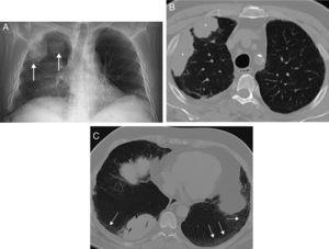 (A) Posteroanterior X-ray of the chest in which several nodular opacities are observed in the right lung (arrow). Note the presence of a subtle bibasal enlargement of the lung interstitium. (B) Axial image of chest CT which confirms the presence of right lung masses (asterisks). (C) Axial image of chest CT (minimum intensity projection) in which a bibasal lung interstitium reticulation (arrows) may be observed in relation to the patient's interstitial lung disease. Note the presence of small traction bronchiectasis.