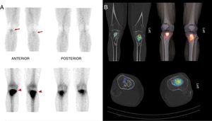 2-Stage scintigraphy (A) showing intense increased radiotracer uptake in the proximal thirds of the tibias. The hybrid SPECT/CT images and 3D reconstruction (B) show osteoblastic activity in the epiphysis of both tibias with no involvement of adjacent soft tissues.