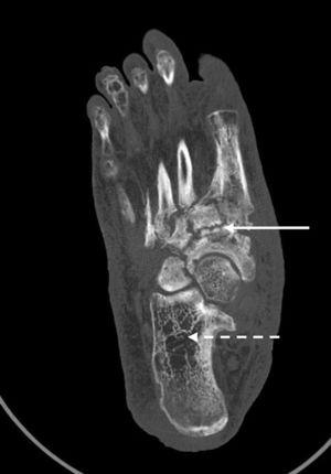 CT scan of right foot: straight white arrow: diffuse involvement with destructuration and bone remodelling of the tarsometatarsal and scaphoid-cuneiform midfoot. Dotted white arrow: radiolucent areas compatible with disuse osteopenia.