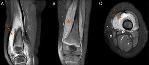 MR imaging of the left knee, STIR sequences with intravenous contrast (IVC). (A) Sagittal slice. (B) Coronal slice. (C) Transversal slice. Major synovitis is observed which affects the suprapatellar bursa (arrows) and muscular hyperintensity of the internal and external vastus lateralis muscles. Compatible with pyomyositis (star).