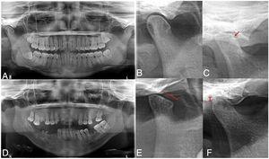 Radiographic temporomandibular disorder in patients with rheumatoid arthritis. The panoramic radiograph revealed greater prevalence of TMD in patients with RA (C–F) compared with individuals from the group without RA (A, B), including greater prevalence of bone erosions (C), condyle deformity (E) and reduction of joint space (F).