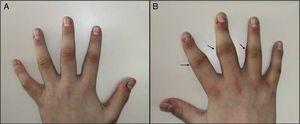 (A, B) Deformity and swelling on the lateral face of the IPJ of the second, third and fourth fingers, with predominance on the right hand (arrows).