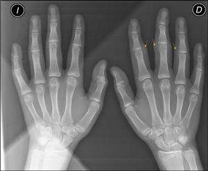Radiographic image with increase in soft tissues on the second, third, and fourth IPJ of the right hand, with no signs of associated joint or bone involvement (arrows).