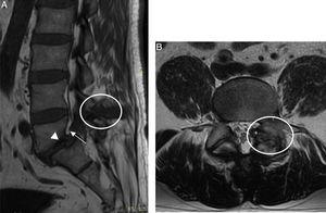 MRI lumbosacral spine (A) Sagittal plane in T1 with hypointense image in L4-L5 interspinous space (circle) invading the neuroforamen (arrow) and spondylolisthesis of L5 (arrow head). (B) Axial plane in T2 with heterogeneous image in left facet joint with bilateral lysis of the interarticular pars (circle).