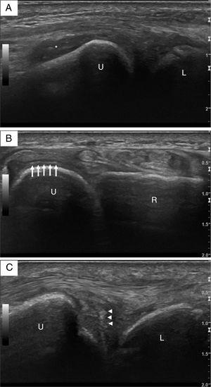 Ultrasound images of the right wrist. (A) Longitudinal view of the distal ulna, with grey-scale grade 2 synovitis of the distal radio-ulnar joint (asterisk). (B) Transverse view of the distal radio-ulnar joint, with an intrahyaline hyperechoic band parallel to the surface of the distal ulnar cartilage (arrows). (C) Several hyperechoic spots with a “punctate pattern” of the triangular fibrocartilage complex (arrow heads). L – lunate; R – radium; U – ulna.