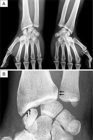 Radiography images of the wrists. (A) Anteroposterior projection, with radio-carpal joint space narrowing and subchondral sclerosis of the radium of the right wrist. (B) Detail of the right wrist, with linear calcifications of the distal radio-ulnar and radio-carpal joints (arrows).