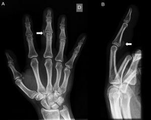 Anteroposterior (Panel A) and lateral (Panel B) radiographs showing well-circumscribed calcification over the radial and volar aspect of the right third finger proximal interphalangeal joint (arrows).