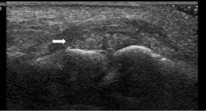 Ultrasound longitudinal view demonstrating an ovoid heterogeneous mass with hyperechoic foci adjacent to proximal interphalangeal joint (arrow).