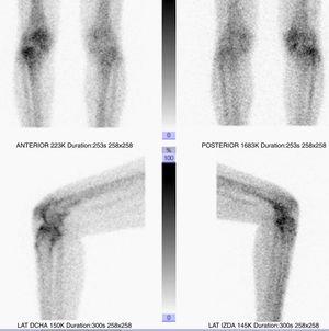 Scintigraphic imaging of the right knee of a female patient aged 47 with rheumatoid arthritis undergoing radioisotope synoviothesis with Ytrium-90.