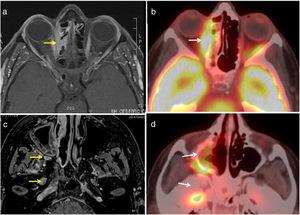 T1-enhanced axial MRI images with fat suppression after IV contrast (a and c) and PET-CT (b and d): hypermetabolism of the right infiltrative orbital-cranial lesion (extraconal space and ethmoid cells, pterygopalatine fossa and foramen ovale).