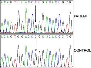 p.R92Q mutation in heterozygosis. Exon 4, TNFRSF1A gene.