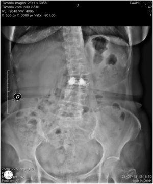 Anterior–posterior lumbar spine radiograph.