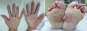 Images of palmoplantar psoriasis in a patient under treatment with anti-TNF.