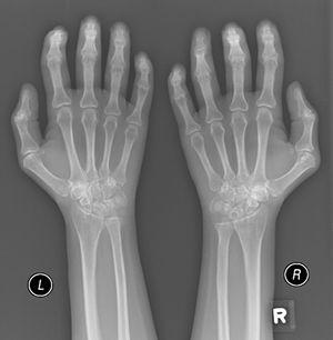 Plain X-ray both hands, showing cystic carpal bone erosions and decreased radio carpal joint space bilaterally, cystic erosions of the upper radius, carpo-metacarpal joints bone erosive changes and joint space narrowing of the proximal interphalangeal joints and metacarpophalangeal joints (MCP) with Juxta-articular osteoporosis.