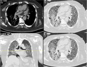 (A) Mediastinal window; (B, C) axial high-resolution lung window; (D) coronal reconstruction (lung window) showing extensive areas of ground glass veiling and opacification together with interstitial sub-pleural infiltrates (interstitial pneumonia and infiltrates).
