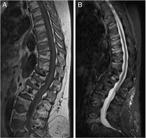 MR images of case 9 taken 9 months after discontinuation of Denosumab, in T1 (A) and STIR sequences (B).