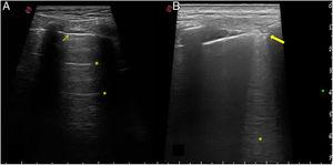 Normal lung ultrasound scan and with interstitial pulmonary disease. Ultrasound scan images showing normal and pathological lungs. A). Normal lung pattern. A fine and regular pleural line can be seen (thin arrow), visible between the costal edges, which leave a posterior shadow, as well as the presence of A lines (asterisks), which are the horizontal hypoechoic lines located under the pleural line at regular intervals. B). Pathological lung pattern. The pleural line shows irregularity, thickening and fragmentation (thick arrow). B lines can be seen (asterisk), which are the hypoechoic vertical lines running from the pleural line to the depth without fading, erasing the A lines.