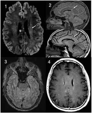 Brain MRI: 1: Axial. Diffusion with hyperintense punctiform lesions in relation to microinfarcts. 2: Sagittal, T2 Flair and T1 sagittal. Characteristic involvement of the corpus callosum. 3: Axial T2 Flair with contrast. hypersignal and leptomeningeal enhancement (additive signal T1 contrast + T2). 4: Axial T1 contrast with “military” uptake pattern.