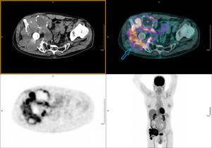 PET-CT performed 60min following intravenous administration of 200.14MBq 18F-FDG. Emission and attenuation-corrected images with low-dose CT, from skull vault to upper third of the thighs (whole body protocol). A hypermetabolic mass in the right iliac region, multi-lobed, of approximately 15×13cm and high uptake intensity (SUVmax 14.64). It encompasses the prosthetic material of the hip and extends cranially towards the iliac muscle, causing bone destruction of the iliac wing, the coxofemoral joint and the ischium (arrow). Ametabolic zones are associated indicative of a necrotic/cystic component (star).