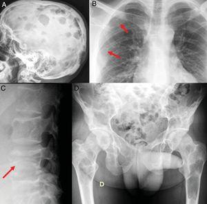 Radiographic bone series. A) Multiple lytic lesions in skull vault with geographic sides and no sclerosis. B) The arrows show the osteolytic lesions in the right posterior fourth and sixth costal arches s. C) Fracture-flattening of L4. D) Extensive injuries in sacrum, pelvis, and both femurs.