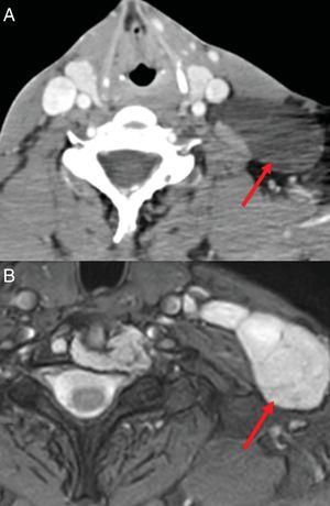 A) cervical CT. B) Axial cervical MR T2 Med. Left laterocervical mass with fluid signal and septa (arrows) related to lymphangioma.