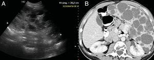 A) Ultrasound of the abdomen. B) CT of the abdomen with intravenous contrast in portal venous phase. Large multicystic splenomegalia of 20cm in longitudinal diameter in relation to diffuse lymphangioma.