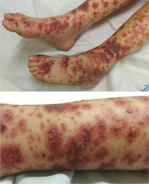 Purpuric lesions with haemorrhagic blisters on lower limbs.