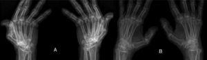 (A) First RA case with anti-Jo-1 positive and showing the typical radiological features of RA in the form of intercarpaljoints, radio-carpal, and carpometacarpal joints erosions PIPs and MCPs erosions with juxta-articular osteoporosis and decreased joint spaces, MCPs subluxations and Z thumb deformity; (B) Second case with RA, and positive anti-Jo-1 showing intercarpal, radio-carpal, and carpometacarpal joints erosions, PIPs and MCP jointserosions with juxta-articular osteoporosis and joint spaces narrowing, consistent with the diagnosis of RA.