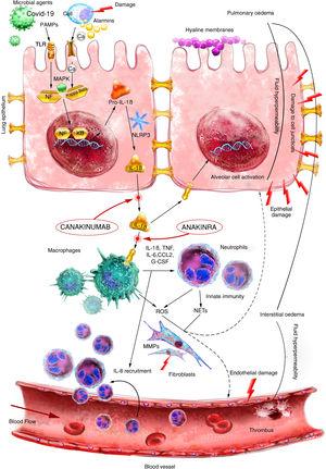 Pathogenesis of acute respiratory distress syndrome (ARDS) is triggered after an initial injury that interacts through alarmin receptors and TLRs that activate nuclear transcription factors, including NF-κB. Subsequently, a potent acute immune response triggered primarily by IL-1ß results in macrophage/neutrophil activation and recruitment. The cell-mediated immune response results in tissue damage, which promotes the development of oedema and epithelial damage. IL: interleukin; MAPK: Mitogen-activated protein kinase; MMPs: Matrix metalloproteinases; NETs: Neutrophil extracellular traps; PAMPS: Pathogen-associated molecular patterns; ROS: Reactive oxygen species; TLR: Toll-like receptor. Source: version adapted from the original by Aranda-Valderrama et al. Scientific illustrator: Miguel Soto.