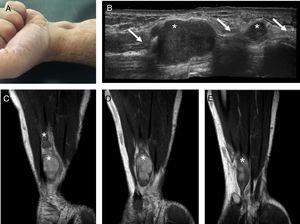 Picture of an enlarging mass on the distal part of the anterior aspect of the forearm and wrist (A). Ultrasound (B) and T1-weighted MRI images (C–E) depict multiple well-defined gadolium-enhanced masses (*) originating from the cubital nerve (arrow) suggestive of cubital nerve schwannoma.