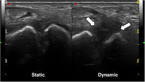 Ultrasound images of the wrist with a high-frequency linear probe; dorsal approach. In the static scan (left image), the scapholunate space appears to be preserved, although a certain hypoechogenicity of the scapholunate ligament can be sensed. However, in the dynamic scan (right image), there is a marked hypoechogenicity with significant scapholunate diastasis, without identifying the ligament with definition, in the context of its rupture.