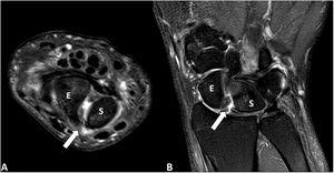 Magnetic resonance imaging. Axial (A) and coronal (B) images of the left wrist in T2-weighted sequences with fat suppression (SPAIR). There is a complete rupture of the dorsal portion of the scapholunate ligament (arrow) producing a significant diastasis between the scaphoid bone (E) and the lunate (S) with minimal effusion and signs of synovitis. There are no foci of MRI signal similar to bone oedema suggestive of inflammation/arthritis or significant osteoarthritic changes.