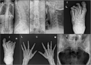 (A & C) Ankylosing spondylitis: X-ray whole spine and thoracolumbar spine AP view showing diffuse syndysmophytic ankylosing giving the Bamboo spine appearance, dagger sign (ossification of interspinous ligament) with bilateral sacroilitis; (B) X-ray of the thoracolumbar spine lateral view showing Romanus lesions (Shiny Corner Sign) due to sclerosis of the vertebral body corners; (D) X-ray cervical spine lateral view showing ossification of the anterior spinal longitudinal ligaments from C3-T1; (E) psoriatic arthritis: X-ray of the left foot AP view with poly-articular erosive arthritis of the lateral 3 MTP joints with subluxation and pencil cup deformity; (F) psoriatic arthritis: X-ray of the right foot AP view showing subluxation of the middle 3 MTP joints with marginal erosions; (G) psoriatic arthritis: X-ray both hands AP view showing sausage shaped right middle finger with erosive arthritis of its PIP joint; (H) ankylosing spondylitis: X-ray of the SIJs AP view showing bilateral and symmetric sacroiliitis with subchondral bony sclerosis on both sides.