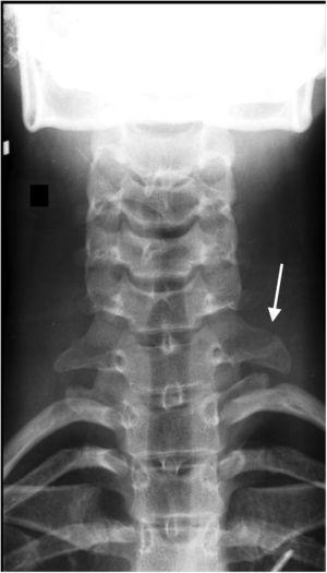 X-ray of the cervical spine with an abnormally elongated C7 left transverse process (white arrow).