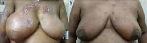 (A) Gross edema and erythematous swelling of right breast with peau d’orange changes and Acute Cutaneous Lupus Erythematous (ACLE) rash over the chest. (B) Complete resolution of the breast edema and healing ACLE rash after four weeks of treatment.