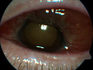 Case 1. Large chemosis with fibrin in pupil area and vitritis that prevents focus on ocular fundus.