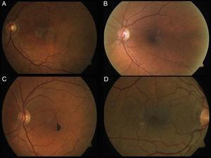 Ocular fundus photograph showing loss of transparency in the juxtafoveal region (A), right-angle vessels (B), RPE with hyperplasia (C) and crystalline deposits (D).