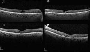 Macular OCT image showing typical lesions: hypo-reflective spaces and outer layer disruption in top images (A and B). Image C shows preserved outer layers, while D shows a case with choroidal nail vascularization.