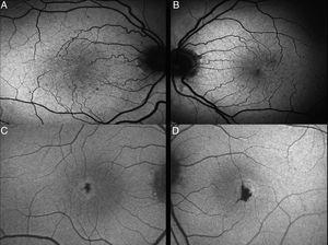 Macular autofluorescence image showing the loss of macular hypoautoflurescence (A and B) and RPE hyperplasia (C and D).