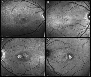 Macular infrared reflectance image showing hypo-reflective perimacular ring and hyper-reflectance areas corresponding to RPE hyperplasia area (D).