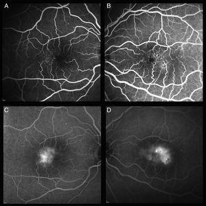 Fluorescein angiography image in early times (A and B) and late times (C and D) in a patient without CNV (C) and another with CNV (D).
