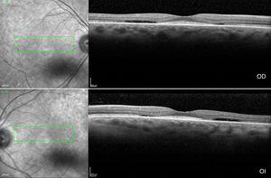 SD-OCT shows the flying saucer sign due to the loss of the perifoveal ellipsoid line with preservation thereof in the foveal region. OD: right eye; OI: left eye.
