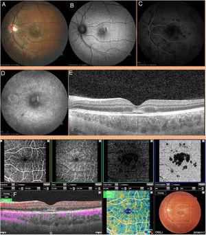 Case 1. (A) White-greyish lesion in central macula. Pale satellite lesions. (B) Mixed pattern in FA. (C) FAG in early times in which the hypofluorescence of the central and satellite lesions can be seen. (D) FAG in more advanced stages with hyperfluorescence at the edges of the lesion. (E) Compromise of external retinal layers, with elevation of the interdigitation zone and increased reflectivity of the layers above. (F) OCT-A. Alteration of choroidal flow in the areas corresponding to the lesions observed in retinography and FAG.