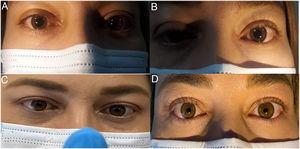 Patient with bilateral pupillary mydriasis. The right pupil (a) and the left pupil (b) show fixed mydriasis not reactive to light. Bilateral pupillary constriction when accommodating (c). After instillation of 0.125% pilocarpine, both pupils show strong constriction (d).