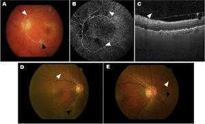 Two cases of eyes with adverse events related to intraocular inflammation (IOI) from the HAWK and HARRIER studies. A–C, case 1: iridocyclitis and RVO. A) Fundus colour photograph shows retinal artery whitening compatible with retinal vascular occlusion (RVO, white arrowhead) and cotton-wool spot (black arrowhead). B) Fluorescein angiography in the venous phase demonstrating lack of retinal arteries perfusion (white arrowheads) and arterial box-carrying (black arrowhead). C) Optical coherence tomography (OCT) image showing the presence of cells in the vitreous in the posterior hyaloid. D–E, case 2: uveitis and RVO. Colour fundus photograph shows small, focal narrowing of retinal arterioles (white arrowhead) and occlusion (black arrowhead). Figure courtesy of Michael Singer et al.,25 licensed under Creative Commons 4.0 International License.