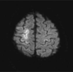 Brain MRI performed 72h after the onset of symptoms. Diffusion weighted imaging: cortical areas with restricted diffusion and serpiginous shape, suggestive of recent venous stroke.