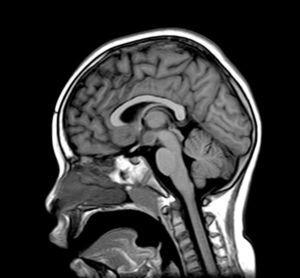Sagittal section, T1-weighted sequence showing a hamartoma in the left hypothalamic region.