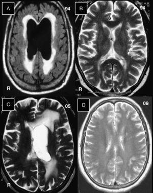 Brain MR images without gadolinium contrast enhancement. (A) In this FLAIR image from 1994, we see bilateral ventricular dilation with hyperintensities around ventricular cavities. (B) T2-weighted image taken 1 month after (A) and after placement of the ventriculo-atrial shunt. The ventricular cavities returned to normal. (C) T2-weighted image from 2005 showing dilation of the lateral ventricle in the left hemisphere and hyperintensities surrounding that ventricle. (D) T2-weighted image from 2009 showing normal-sized lateral ventricles and no changes to the cerebral parenchyma.