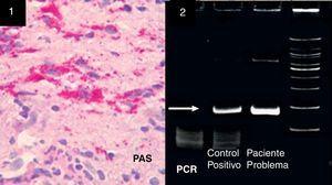 (1) Biopsy sample of brain and intraventricular adhesion tissue subjected to periodic acid Schiff test (PAS+), revealing lymphocytes and macrophages containing material consistent with TW bacteria. (2) Polymerase chain reaction (PCR) test; TW detected with 16s ribosomal RNA sequencing. These oligonucleotides can detect fragments of 160 base pairs in the presence of bacterial DNA. The white arrow indicates the intense white band in the column indicating our patient sample, compared to a positive control.